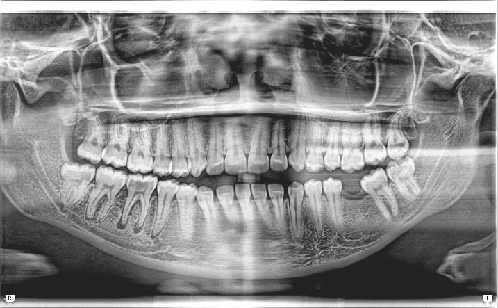 Full Mouth Digital Panorex X-Ray