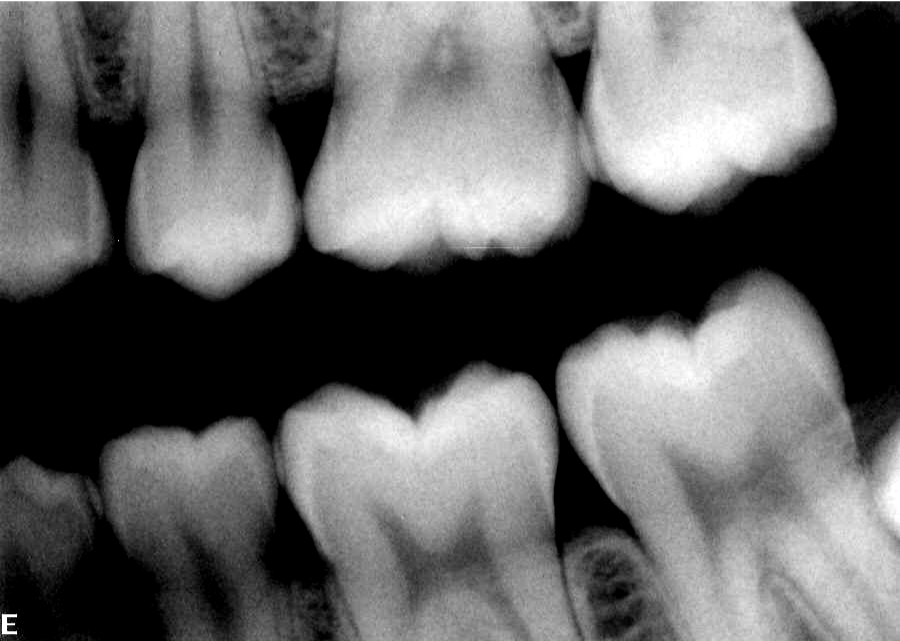 Bite Wing X-Ray Bite Wing X-Ray